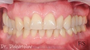 Комбинированная работа Zr на имплантаты и на свои зубы